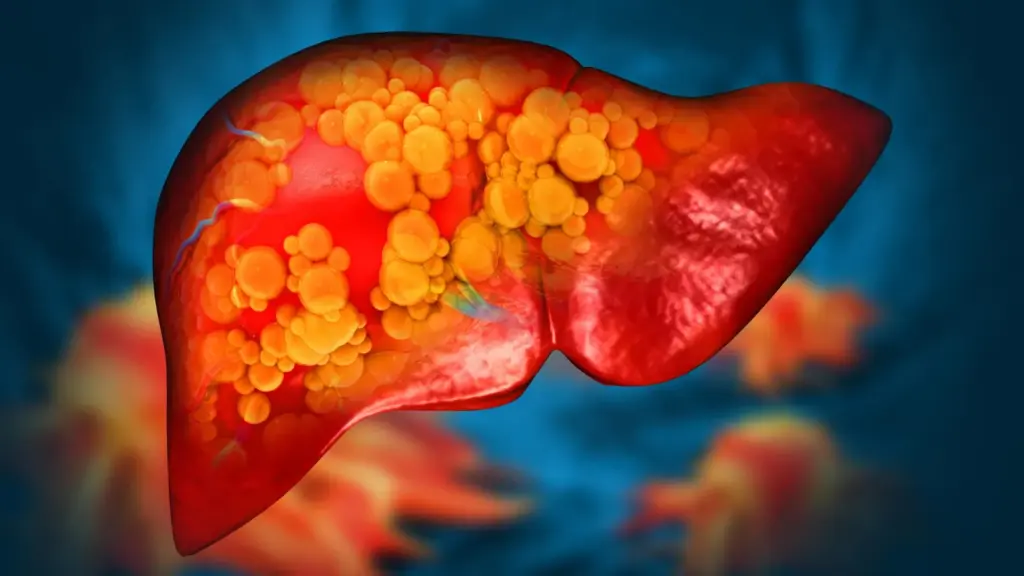 Experimental Drug Targets the Gut to Reverse Severe Fatty Liver Disease