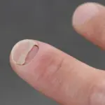 New Research Links Popular GLP-1 Weight Loss Medications to Unexpected Nail and Scalp Issues