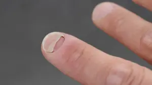 New Research Links Popular GLP-1 Weight Loss Medications to Unexpected Nail and Scalp Issues