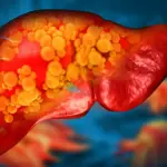 Novel Drug Therapy Targets the Gut to Reverse Severe Fatty Liver Disease