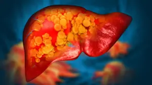 Novel Drug Therapy Targets the Gut to Reverse Severe Fatty Liver Disease