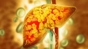Researchers Identify Key Enzyme That Could Prevent Severe Liver Disease Progression