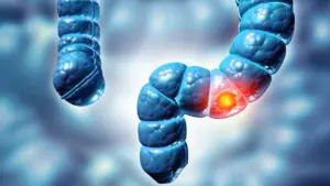 Rising Rates of Advanced Colorectal Cancer in Young Patients Spark Urgent Call for Earlier Detection